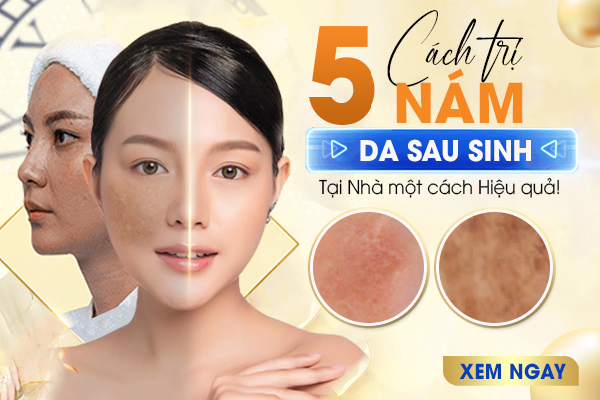Bí quyết xóa mờ Nám da sau sinh hiệu quả tại nhà