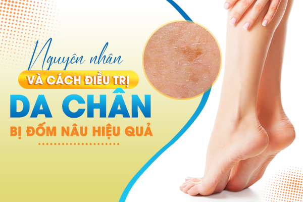 Chân xuất hiện nhiều đốm nâu: Nguyên nhân, dấu hiệu và cách điều trị hiệu quả