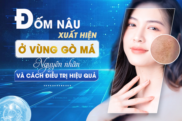 Đốm nâu xuất hiện ở Gò má: Đâu là nguyên nhân và cách điều trị?
