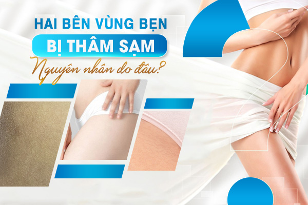 Hai bên bẹn bị thâm nguyên nhân do đâu? Cách điều trị hiệu quả