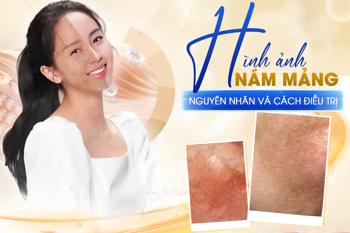 Hình ảnh Nám Mảng trên Da - Nguyên nhân và cách điều trị