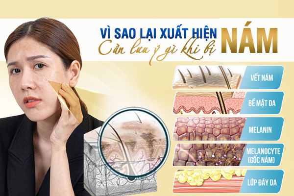 Vì sao lại xuất hiện nám và cần lưu ý gì khi bị nám ?