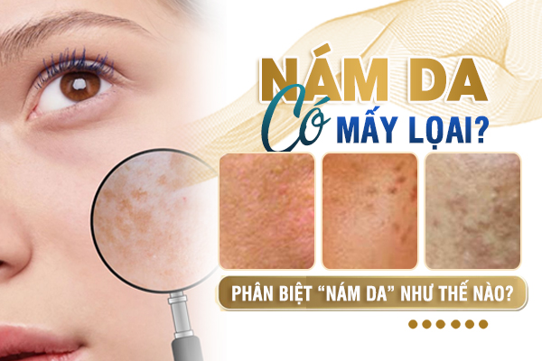 Nám có mấy loại và phân biệt như thế nào?