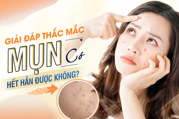 Mụn có thể hết hẳn được không?