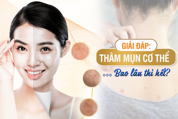 Thâm mụn cơ thể bao lâu thì hết? Cách trị thâm mụn hiệu quả