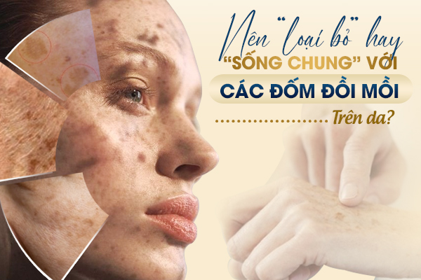 Nên loại bỏ hay “sống chung” với các đốm đồi mồi trên da?