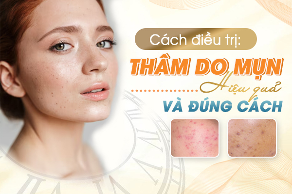 Cách điều trị Thâm do Mụn hiệu quả và đúng cách