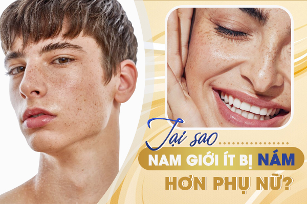 Giải mã Nguyên nhân: Tại sao nam giới lại ít bị nám hơn phụ nữ?