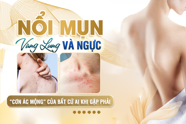 Nguyên nhân gây ra tình trạng mụn ở vùng lưng, ngực