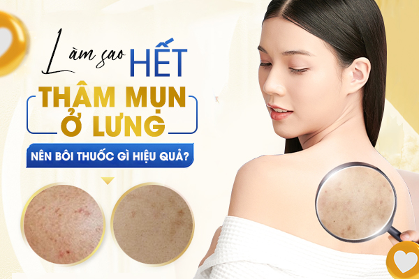 Làm sao để hết thâm mụn ở lưng? Nên bôi thuốc gì hiệu quả?