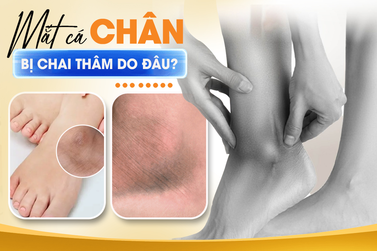 Mắt cá chân bị chai thâm do đâu? 5 Cách trị thâm mắt cá chân hiệu quả