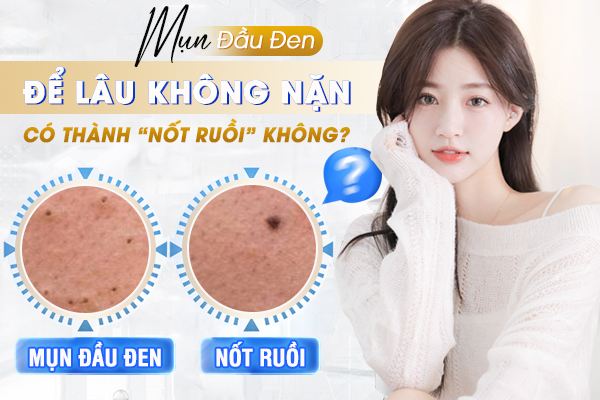 Mụn đầu đen để lâu không nặn có thành nốt ruồi không?