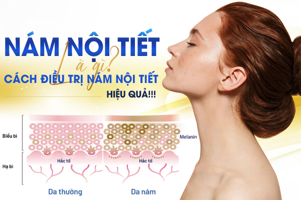 Nám nội tiết là gì? Cách điều trị nám nội tiết hiệu quả