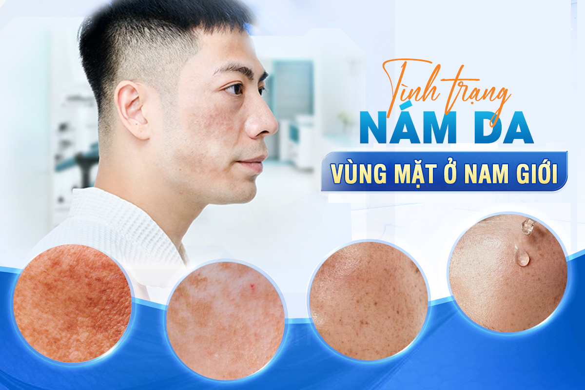 Trị nám da mặt cho nam giới an toàn và hiệu quả cao