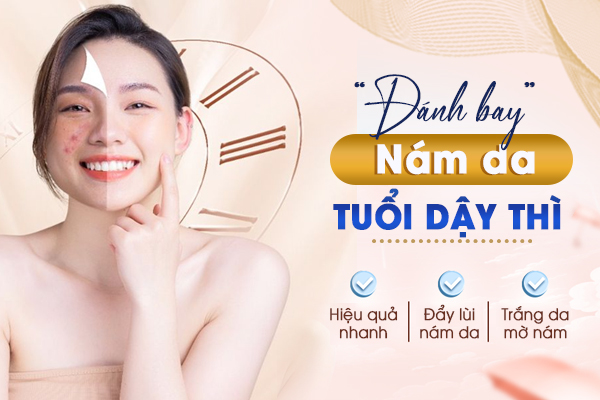 Giải pháp “Đánh bay”nám da ở tuổi dậy thì như thế nào hiệu quả?