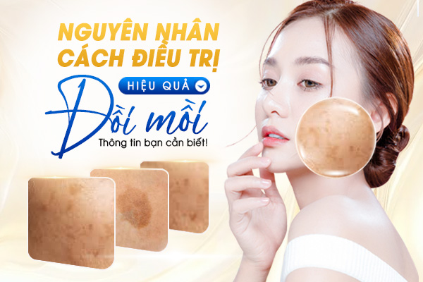 Đồi Mồi: Nguyên Nhân và Cách Điều Trị Hiệu Quả Bạn Cần Biết!