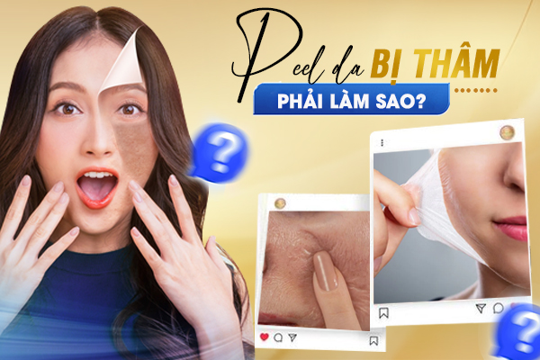 Peel da bị thâm phải làm sao? Cách điều trị hiệu quả