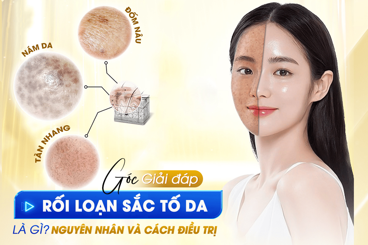 Rối loạn sắc tố da là gì? Nguyên nhân và cách điều trị hiệu quả