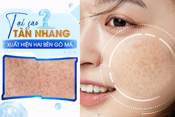 Tại sao Tàn nhang thường xuất hiện hai bên gò má?