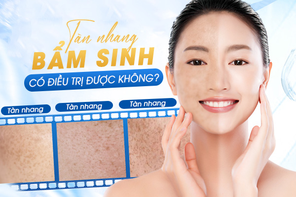 Tàn nhang bẩm sinh có điều trị được không?