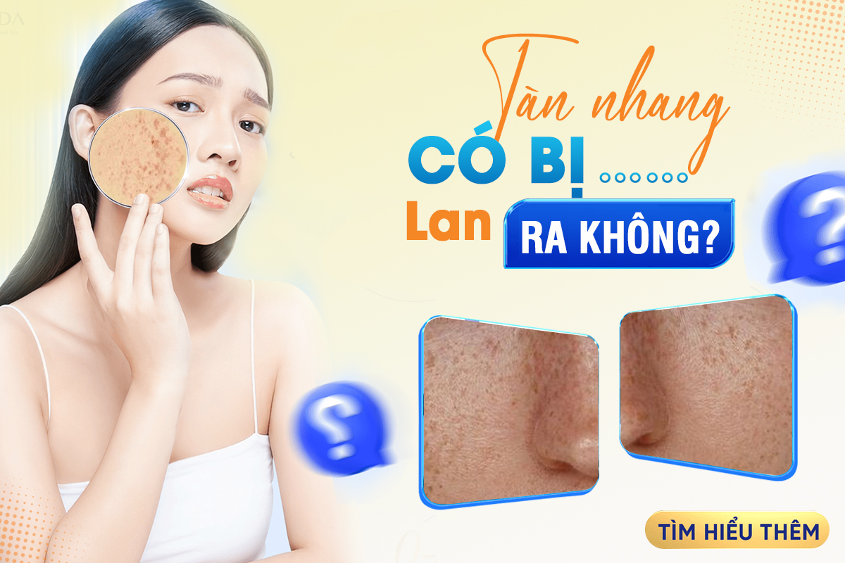 Tàn nhang có bị lan ra không? Các Cách điều trị hiệu quả