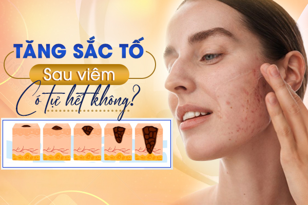 Góc giải đáp: Tăng sắc tố sau viêm là gì? Có tự hết không?