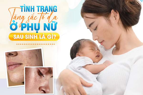 Tăng sắc tố da ở phụ nữ sau sinh, điều trị thế nào?