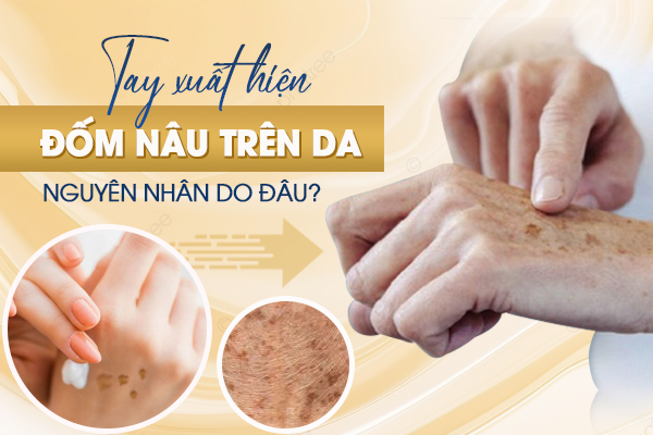 Tay xuất hiện đốm nâu nguyên nhân do đâu? Dấu hiệu và cách điều trị hiệu quả