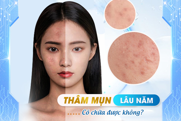 Thâm Mụn Lâu Năm Có Chữa Được Không? Tìm Hiểu Ngay!
