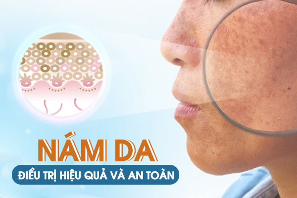 Các phương pháp điều trị nám da hiệu quả và an toàn hiện nay