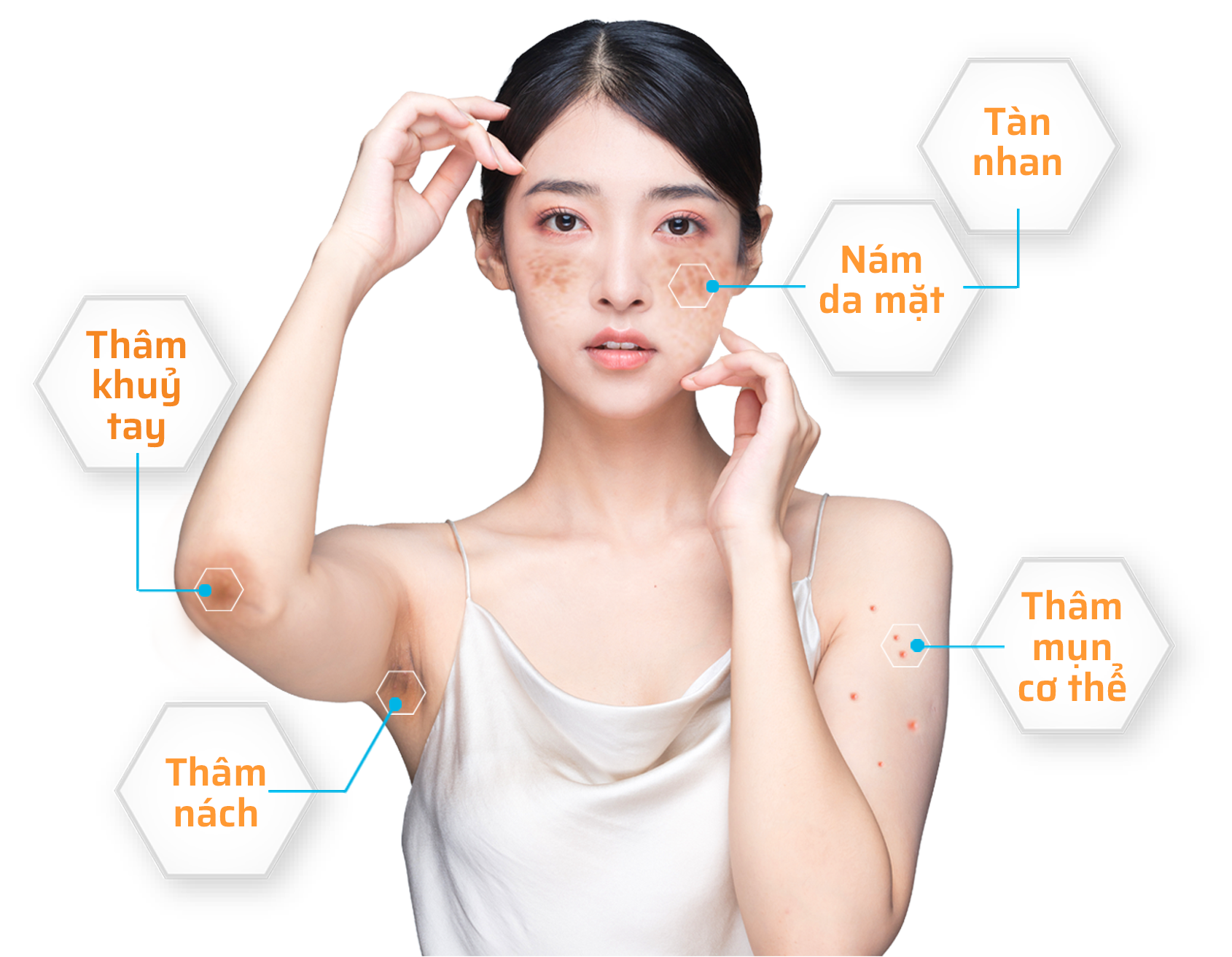 ại sao HYDROQUINONE là hoạt chất vàng trong điều trị nám và tăng sắc tố da ?